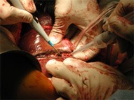 Liver Resection